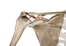 Acromioclavicular (AC) separation