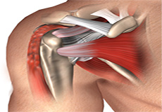 Bicep Tenodesis