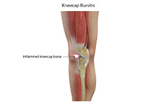 Bursitis