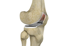 Chondromalacia Patella