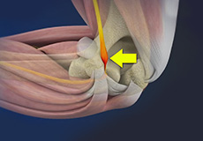 Ulnar Nerve Entrapment