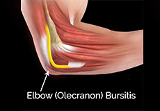 Elbow Bursitis