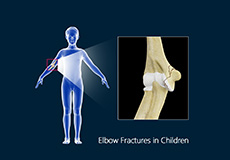 Forearms Fracture in Children