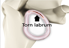 Glenoid Labrum Tear