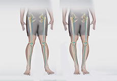 Knee Angular Deformities