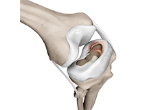 Meniscal Injuries