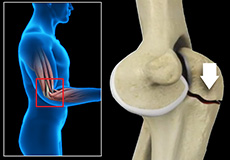 Olecranon (Elbow) Fractures