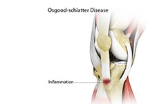 Osgood Schlatter Disease