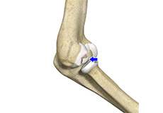 Osteochondritis Dissecans