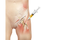 Platelet Rich Plasma Injection (PRP)