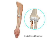 Radial Head Fractures