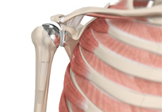 Shoulder Joint Replacement