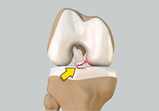 Tibial Eminence Spine Avulsions